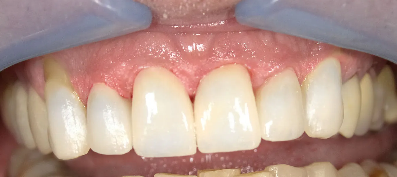 Smile results after one-visit CEREC crowns and veneers.