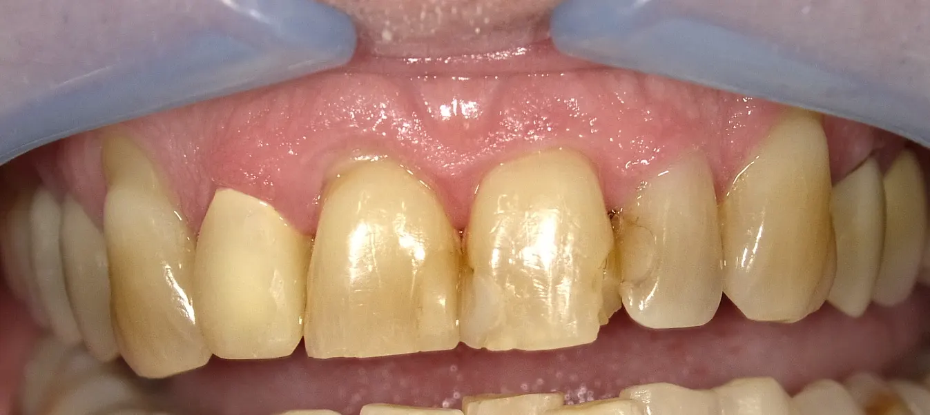 Patient’s teeth before CEREC same-day crowns and veneers treatment